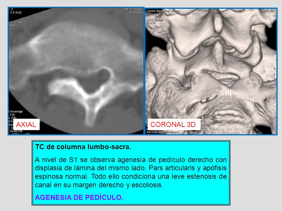 agenesia de la columna